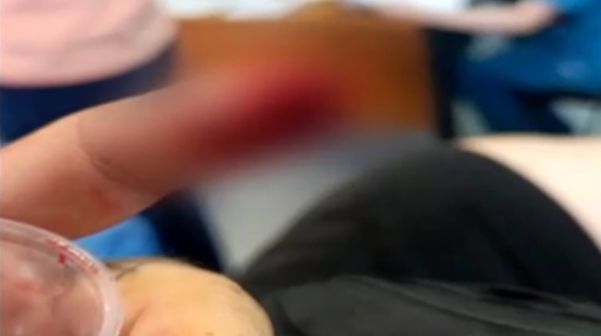 Το κομμένο δάχτυλο του 23χρονου