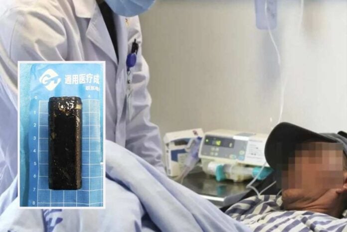 anaptiras_china_1 Άνθρωπος στην Κίνα κατάπιε αναπτήρα και λειτουργούσε μετά από 30 χρόνια